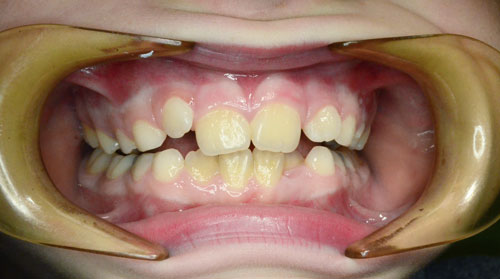 Nenabarvený zubní plak