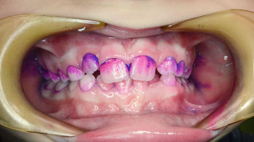 Nabarvený zubní plak