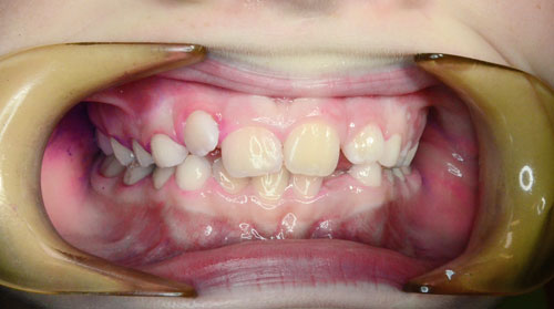 Vyčištěné zuby znovu nabarvené