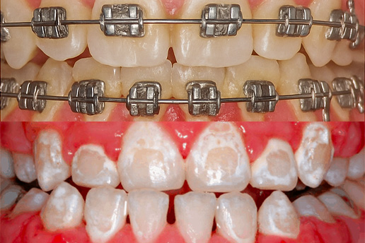 Co se stane, když se rovnátka nasadí na špatně čištěné zuby?